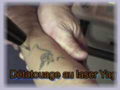 detatouage laser